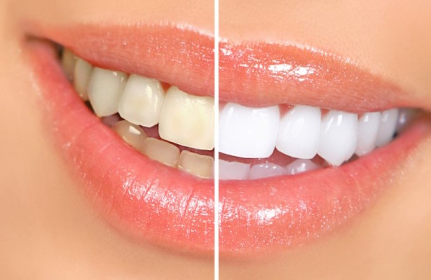 denti-bianchi